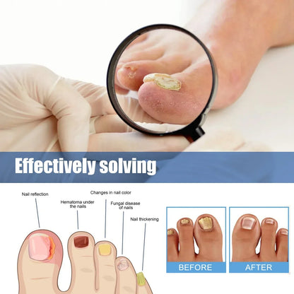 Fungus Nail Repair Patches